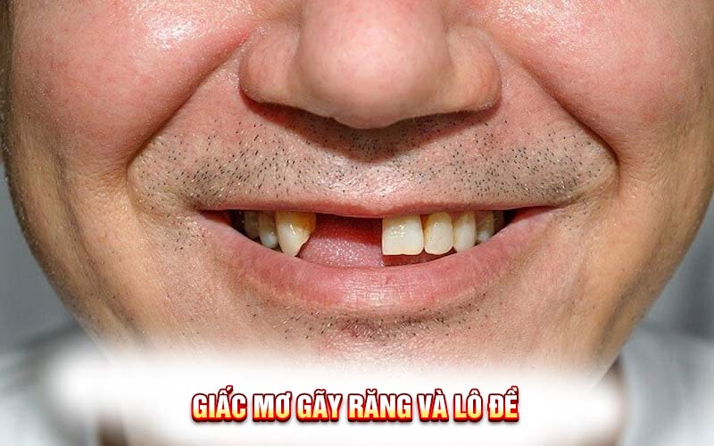 Giải Mã Giấc Mơ Gãy Răng: Sự Thật Sau Giấc Mơ Đáng Sợ Này!